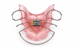 2-Way Palatal Expander - Image 3