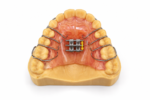 2-Way Palatal Expander - Image 2