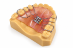 2-Way Palatal Expander