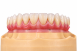Implant Crown Restoration - Image 2