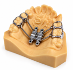 Bone-borne Expander