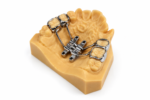 Bone-borne Expander - Image 2
