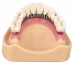 Implant Crown Restoration - Image 4