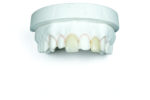 Porcelain Veneers - Image 3