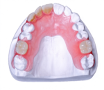 Flexible Resin Partial Dentures - Image 3