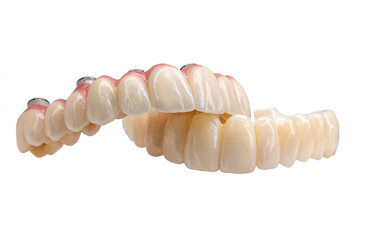 237cfa60e71c7c47f7b4a59f409cf7af Implant-Supported Fixed Bridges - Image 1
