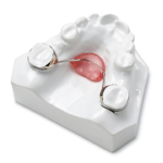 Nance Palatal Arch Appliances - Image 3