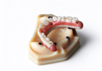 PEEK Removable Partial Denture Frameworks