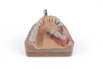 Precision Attachment Partial Dentures - Image 2