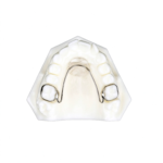 Nance Palatal Arch Appliances - Image 4