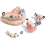 Precision Attachment Partial Dentures