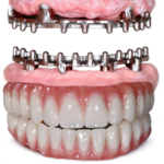 Titanium Framework Restorations - Image 3