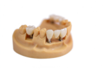 Screw-Retained Implant Crowns - Image 2