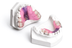 Functional Orthodontic Appliances