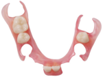 Flexible Partial Dentures with Tooth-Colored Clasps - Image 3