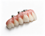 Implant-Supported Fixed Bridges - Image 4