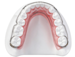 Wraparound Retainers - Image 2