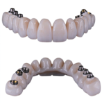 PMMA Full-Arch Provisional Restorations