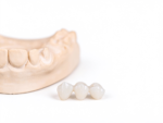Screw-Retained Implant Crowns - Image 4
