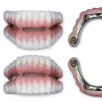 PMMA Full-Arch Provisional Restorations - Image 3