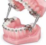 Fixed Bite Correctors - Image 2