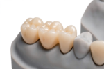 Zirconia Fixed Bridges - Image 3