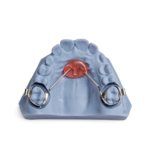 Nance Palatal Arch Appliances - Image 2