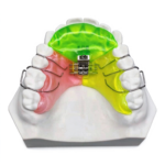 Removable Expansion Plates