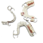 PEEK Removable Partial Denture Frameworks - Image 2