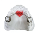 Nance Palatal Arch Appliances
