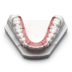 Wraparound Retainers - Image 4