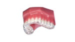 Stabilization Occlusal Splints - Image 2