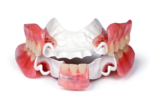 PEEK Full-Arch Prosthetic Frameworks - Image 2