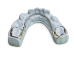 Lower Lingual Holding Arches - Image 3