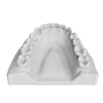 Fixed Lingual Retainers
