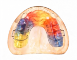 Stabilization Occlusal Splints