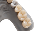 Zirconia Fixed Bridges
