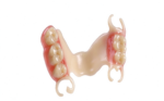 Flexible Partial Dentures with Tooth-Colored Clasps - Image 2