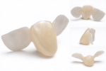 Maryland Adhesive Bridges - Image 3
