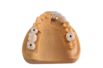 Screw-Retained Implant Crowns