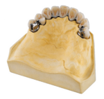 Precision Attachment Partial Dentures - Image 3