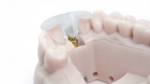 Cement-Retained Implant Crowns - Image 4