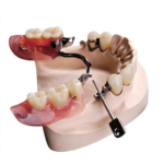 Precision Attachment Partial Dentures - Image 2