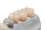 Zirconia Fixed Bridges - Image 2