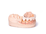 Screw-Retained Implant Crowns - Image 3