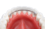 Fixed Lingual Retainers - Image 3