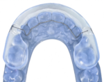Fixed Lingual Retainers - Image 4