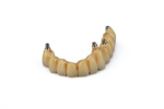 Implant-Supported Fixed Bridges - Image 3