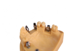 Custom Implant Abutments