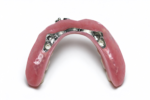 Titanium Framework Restorations - Image 2